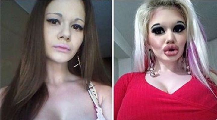 Andrea Emilova Ivanova labbra prima dopo (1)