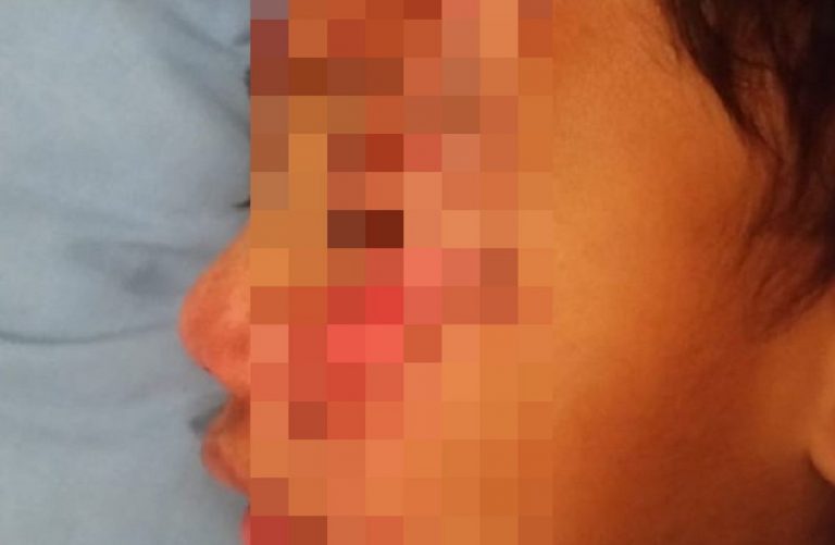 figlio disabile sfigurato