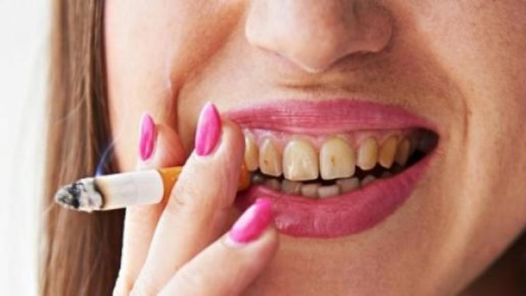 Denti macchiati.