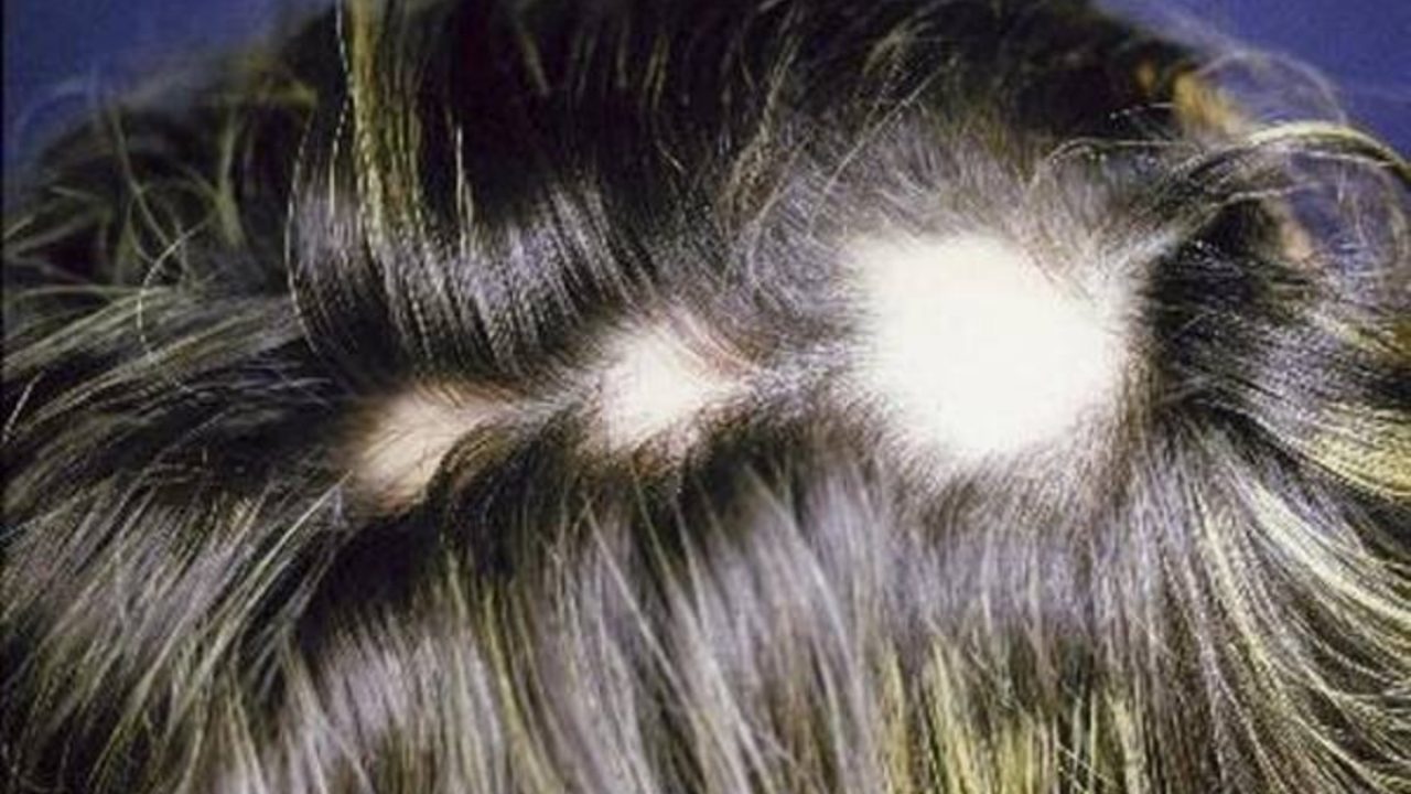 Alopecia areata femminile: le cause e le cure naturali | Notizie.it