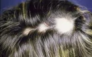 alopecia areata femminile