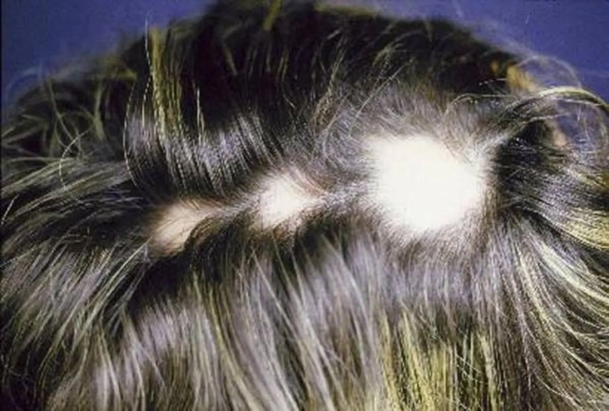 alopecia areata femminile