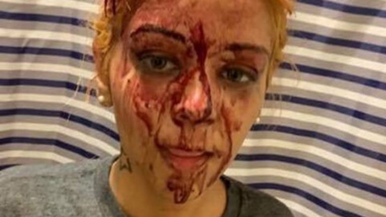 donna picchiata dal fidanzato