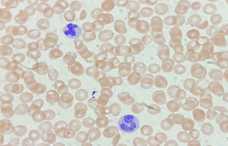 leucemia