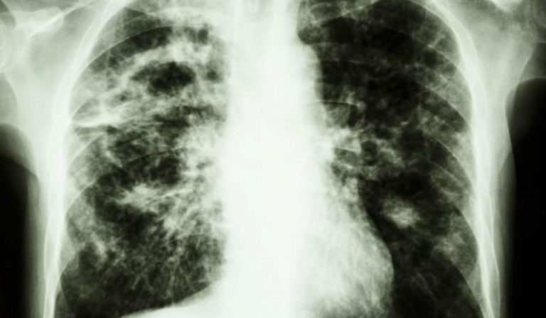 Regno Unito, neonato morto per tubercolosi: si teme il contagio