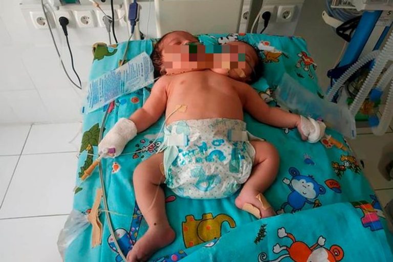 gemelli siamesi morti