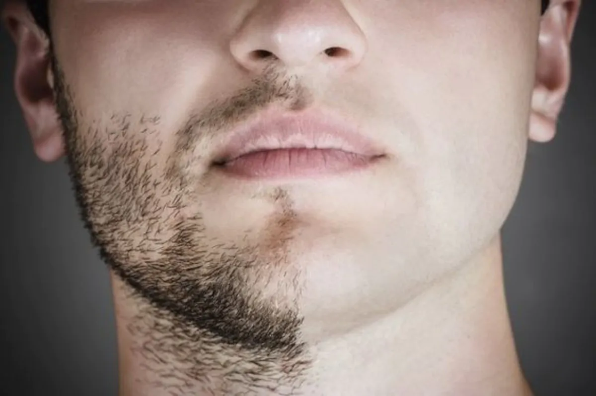 alopecia della barba