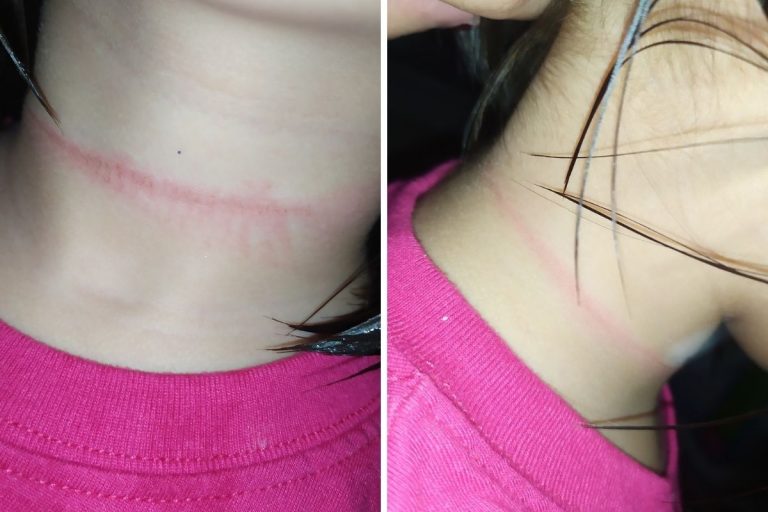 bambina rischia di morire TikTok