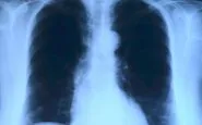 covid effetti polmoni