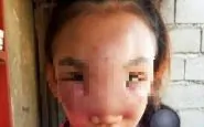 filippine gonfiore sul viso rischia di perdere la vista_censored