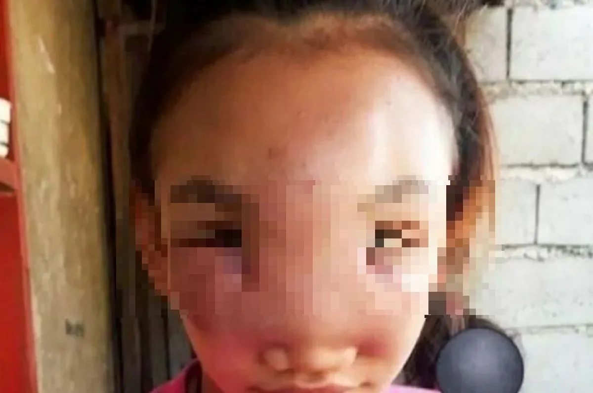 filippine gonfiore sul viso rischia di perdere la vista_censored