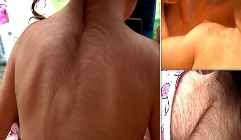 minoxidil ai bimbi al posto di un inibitore di pompa protonica