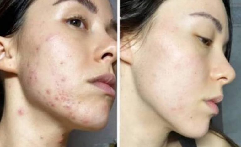 Aurora Ramazzotti acne