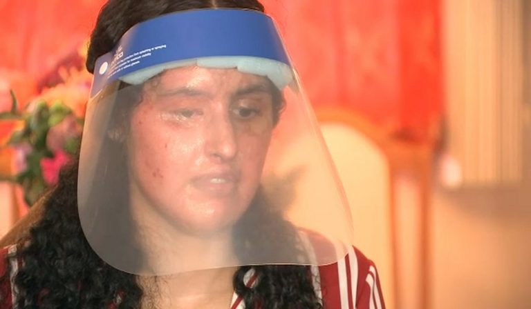Aggredita con l'acido, studentessa ustionata in volto e sulle braccia