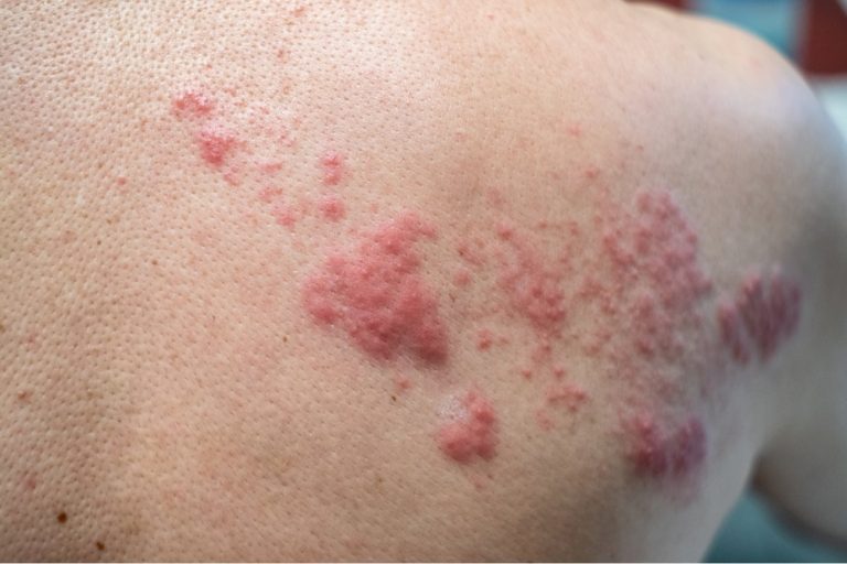 covid herpes vaccino