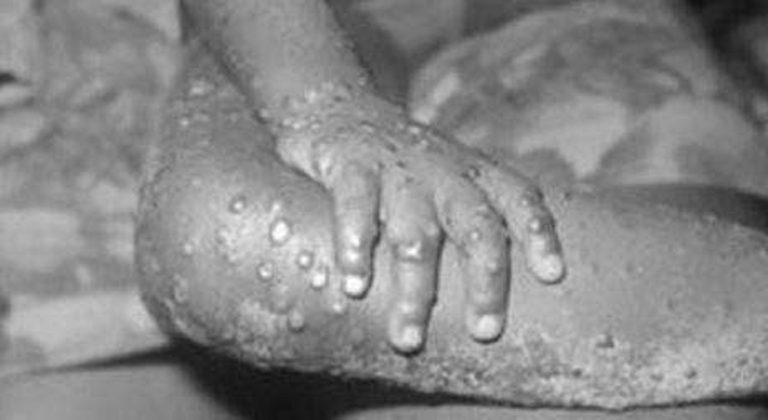 Le pustole del "Monkeypox"