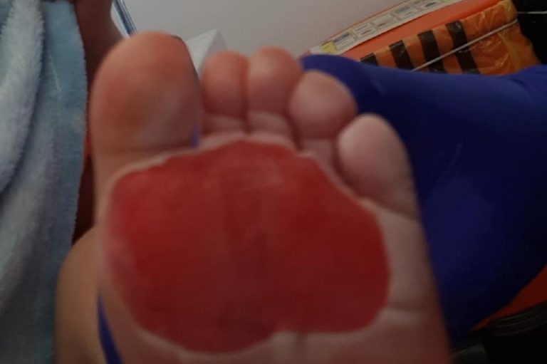 la foto con le terribili ustioni ai piedini del bambino