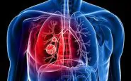 Cancro ai polmoni: i sintomi a cui fare attenzione