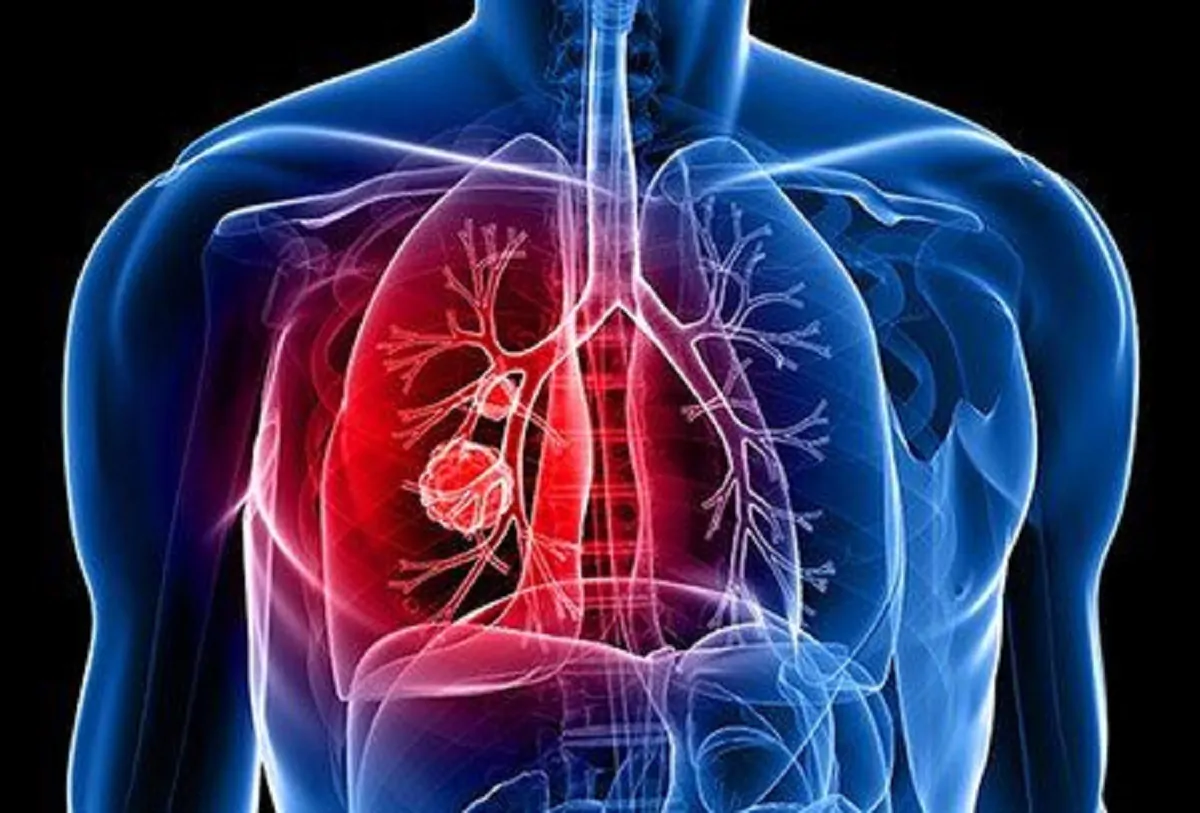 Cancro ai polmoni: i sintomi a cui fare attenzione