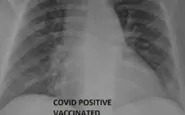 La radiografia polmonare di una persona positiva al covid ma vaccinata