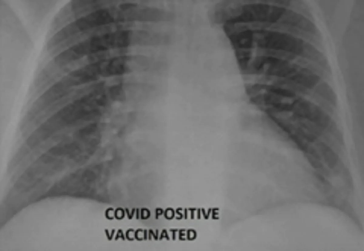 La radiografia polmonare di una persona positiva al covid ma vaccinata