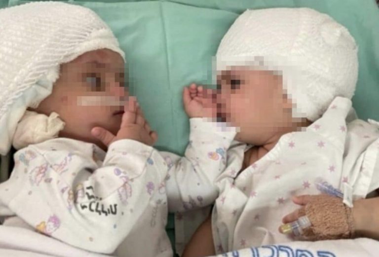 Gemelle siamesi operate in Israele