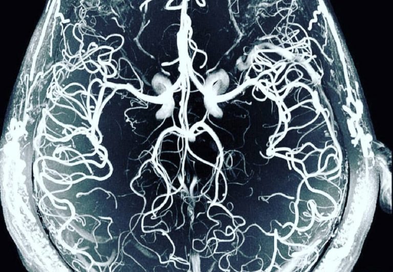 Uno studio italiani indica il legame fra Covid ed alterazioni del cervello