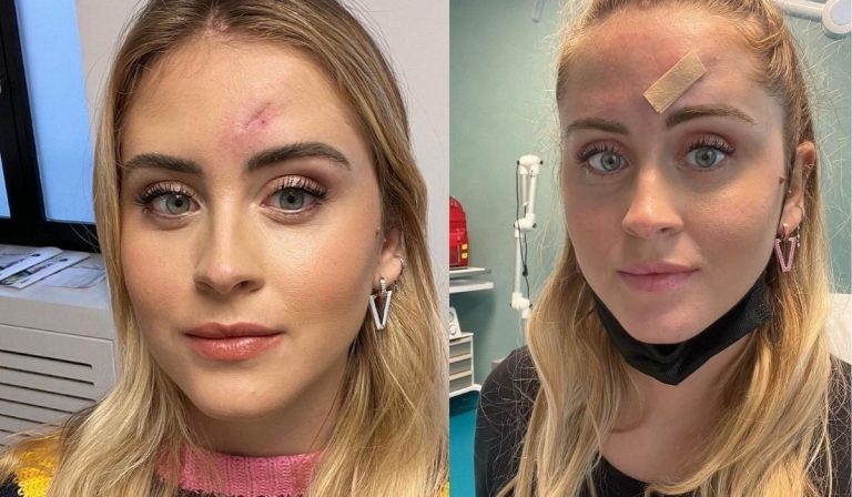 Valentina Ferragni cicatrice