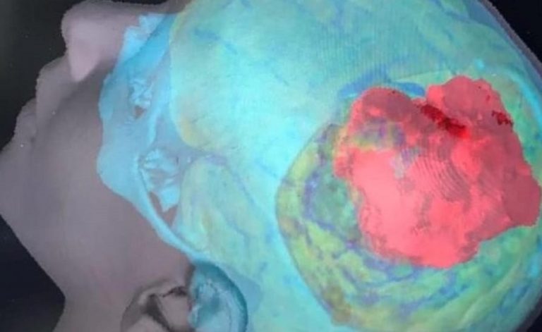 La visualizzazione 3D del tumore nel cranio del bambino