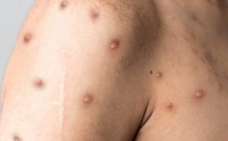 Il primo focolaio di monkeypox potrebbe aver avuto origine alle Canarie