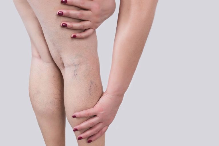 Vene varicose: i rimedi per l’estate