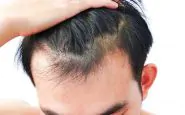 alopecia maschile