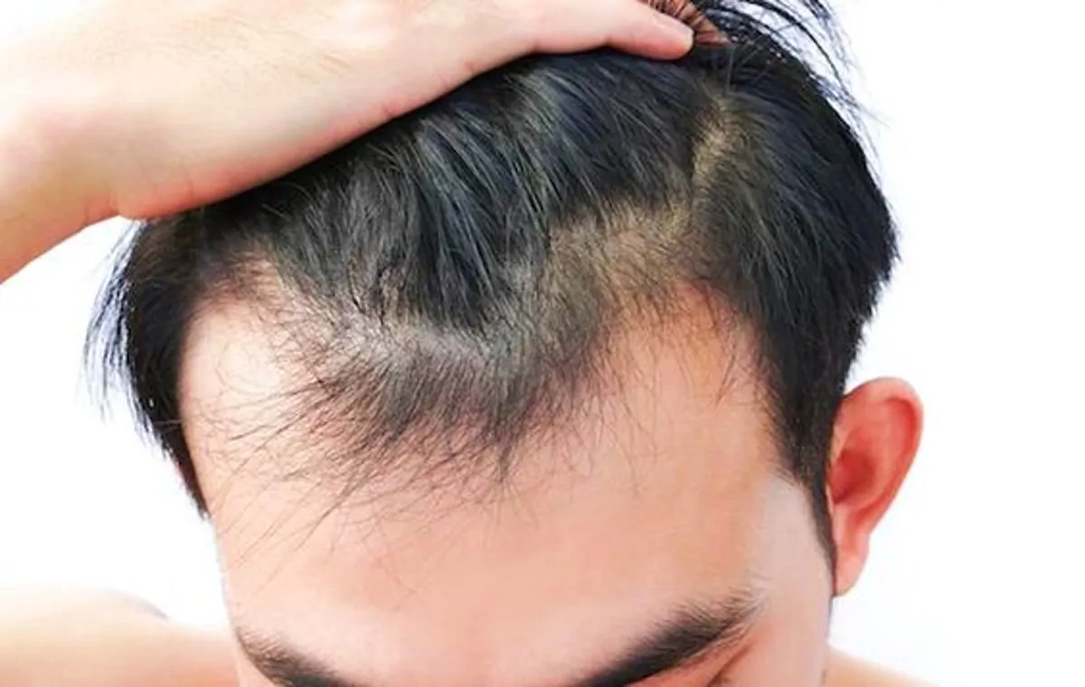 alopecia maschile