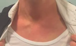 La dottoressa Andriani mostra i segni sul collo