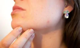 Acne sul viso: i consigli su come curarla