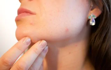 Acne sul viso: i consigli su come curarla