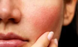 Couperose: cos’è e come curarla con i rimedi naturali