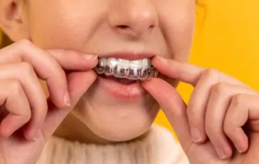 Apparecchi trasparenti: il futuro dell’ortodonzia estetica