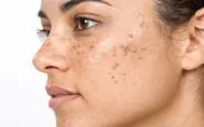 Macchie del sole sulla pelle: come difendersi naturalmente