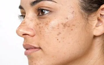 Macchie del sole sulla pelle: come difendersi naturalmente