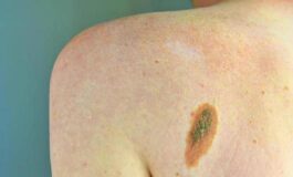 Melanoma Adoi Bene nuova legge su prevenzione dermatologo centrale in screening 265x160