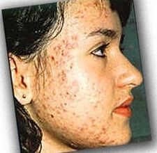 rimedi per cicatrici acne