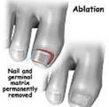 article page main ehow images a04 g2 tb heal ingrown toenail 800x8001