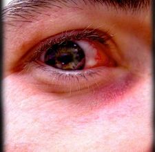 article page main ehow images a04 pk r2 cure pinkeye 800x800