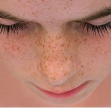 article page main ehow images a04 80 k2 remove freckles 800x800