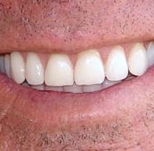 article page main ehow images a04 pc o5 whiten teeth natural way 800x800